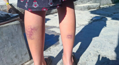 कम अंक ल्याएको भन्दै कक्षा १२ की छात्रालाई शिक्षकले कुटे, पिडौंलामा नीलडाम